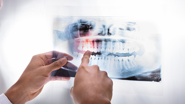 Ukiah Oral Surgery   Dental Implants | Oral   Facial Trauma, Frenectomy and Apicoectomy