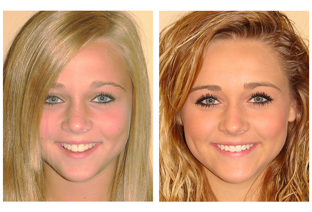 Ukiah Oral Surgery Dental Implants